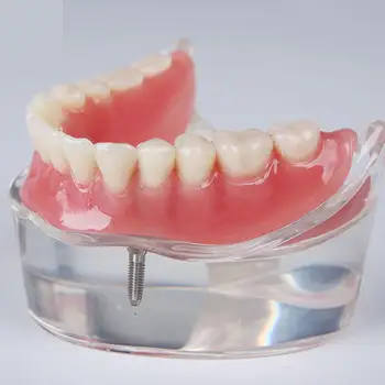 Демонстрационная модель для изучения зубов Overdenture Inferior 4 Implant